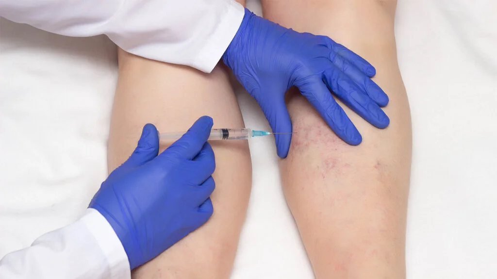 What Is Sclerotherapy for Varicose Veins?